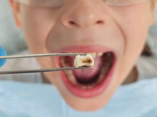 Best Urgent Care for Lost Fillings or Crowns in Lemoore Station, CA